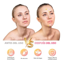 200pzs Mascarillas Estrella Para El Acne Espinillas Granos