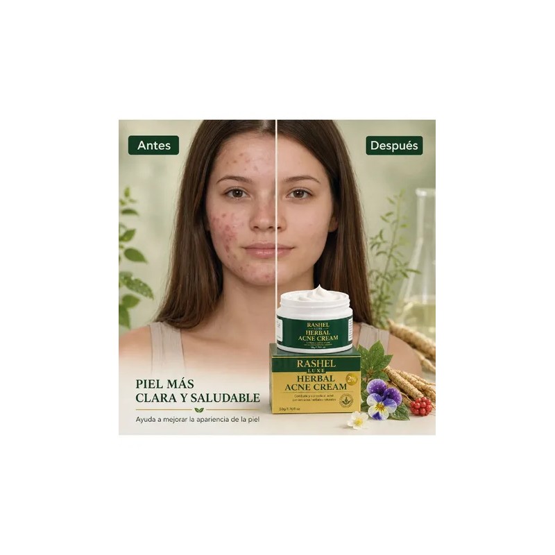 Crema Herbal Tratamiento Acné, Control Grasa, Minimiza Poros