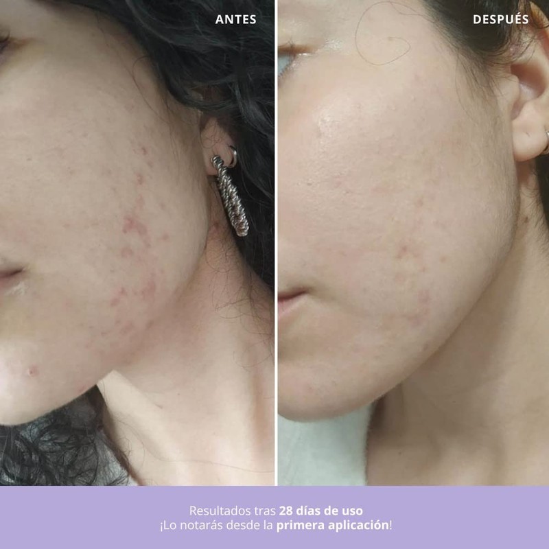100% natural treatment of acne and reactive skin on the
