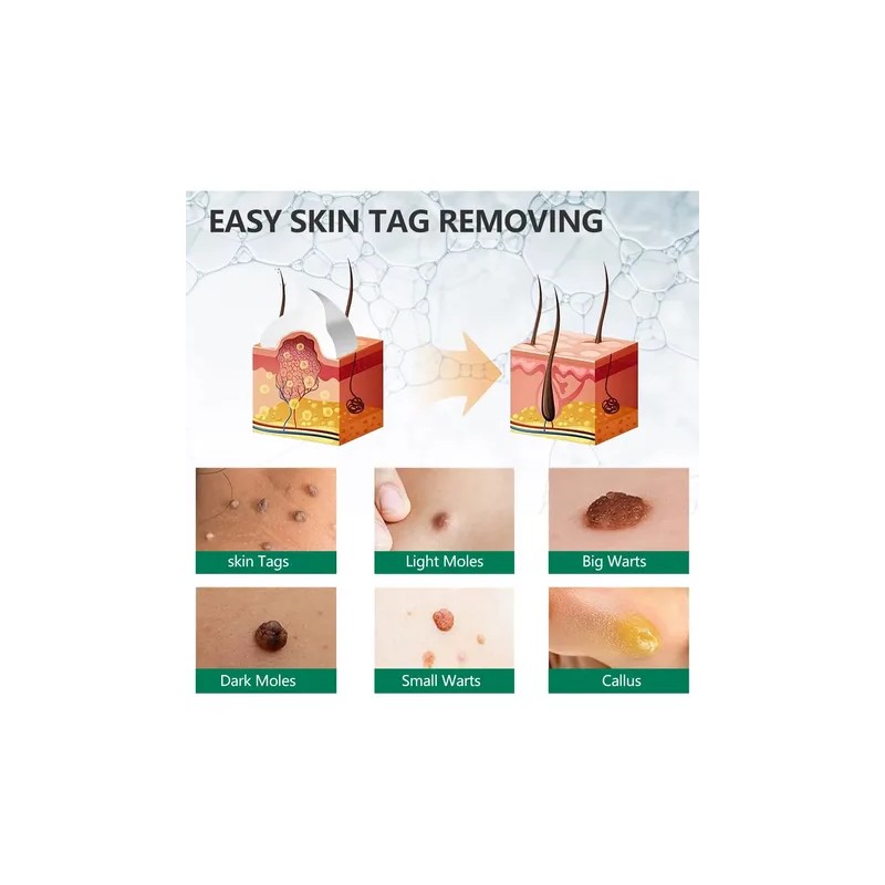 Crema Herbal Piel Removedora Verrugas 100 % Natural Segura