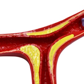 Human Atherosclerosis Cardiovascular Model Blood Vessel Anatomical Model Medical Teaching Supplies 10 Times