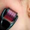 Dermaroller Lynnette Titanio 0.5 mm 540 Agujas Para Rostro