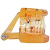 Dental Model Dental Disease Teaching Model Removable Implant Teeth Model