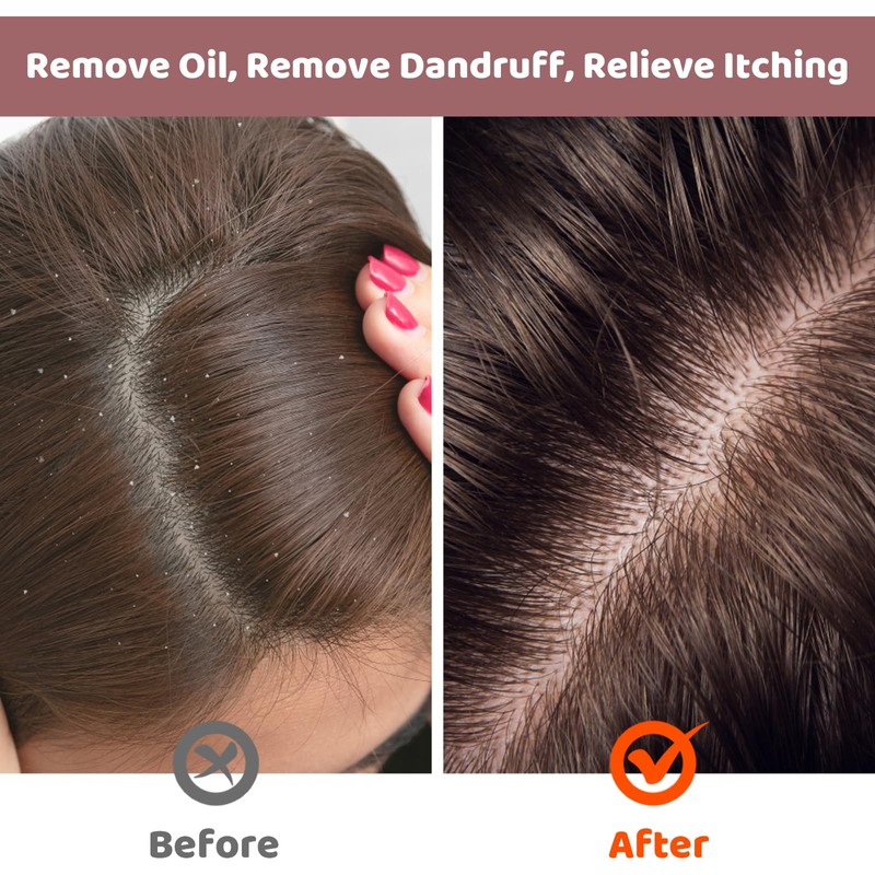 4 Dandruff Combs, Scalp Massage Comb for Dandruff Removal and