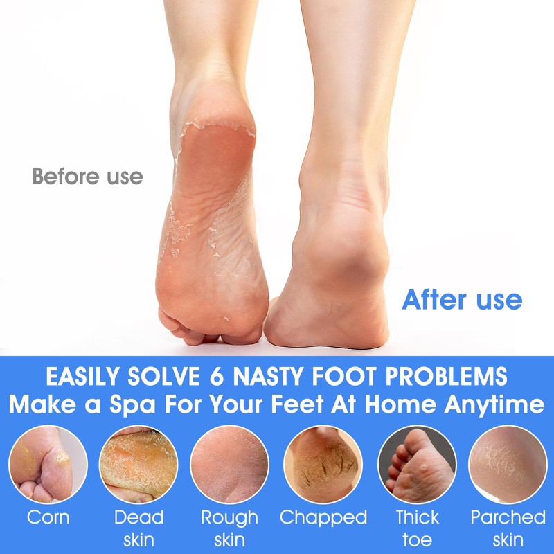 ElevateTech 4Pcs Pumice Stone for Feet, Foot Callus Remover Pedicure