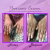 Crema Facial & Corporal Psoriasis Cream Hidratante Aliviante