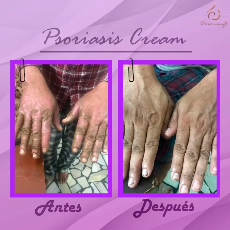 Crema Facial & Corporal Psoriasis Cream Hidratante Aliviante