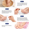 Tratamiento De Hongos En Las Uñas De Los Pies Extra