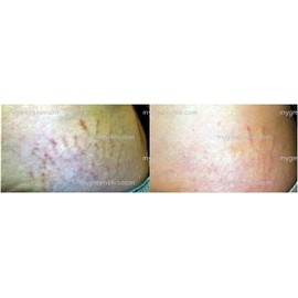 Best Stretch Mark Microdermabrasion Crystals- Most Effective treatment for Old White Stretch Marks pure Stretch Mark Microdermabrasion Medical Crystals for manual use 2lbs shown to remove dead skin cells, exfoliate rough skin,repair scars and old white stretch marks, fade sunspots from sun damage, leaves skin glowing, smooth and younger looking
