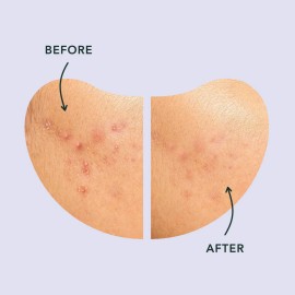 Patches De Espinilla Rael, Parches Milagrosos Cubierta De Co