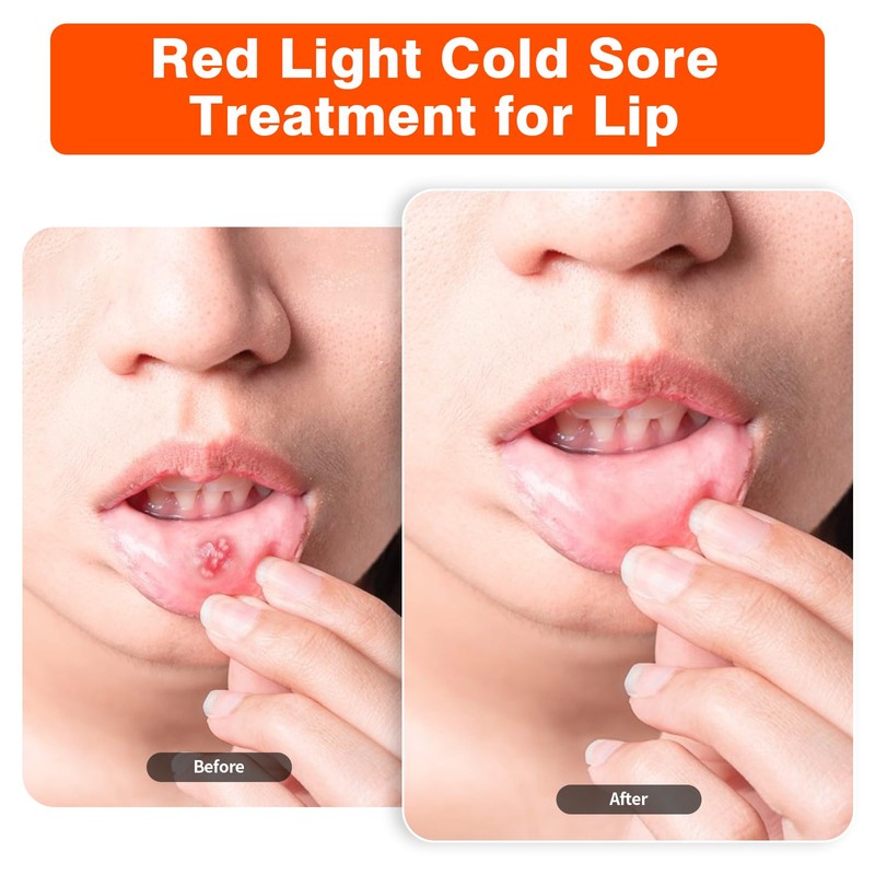 Red Light Cold Sore, Cold Sore Treatment Device, Red Light