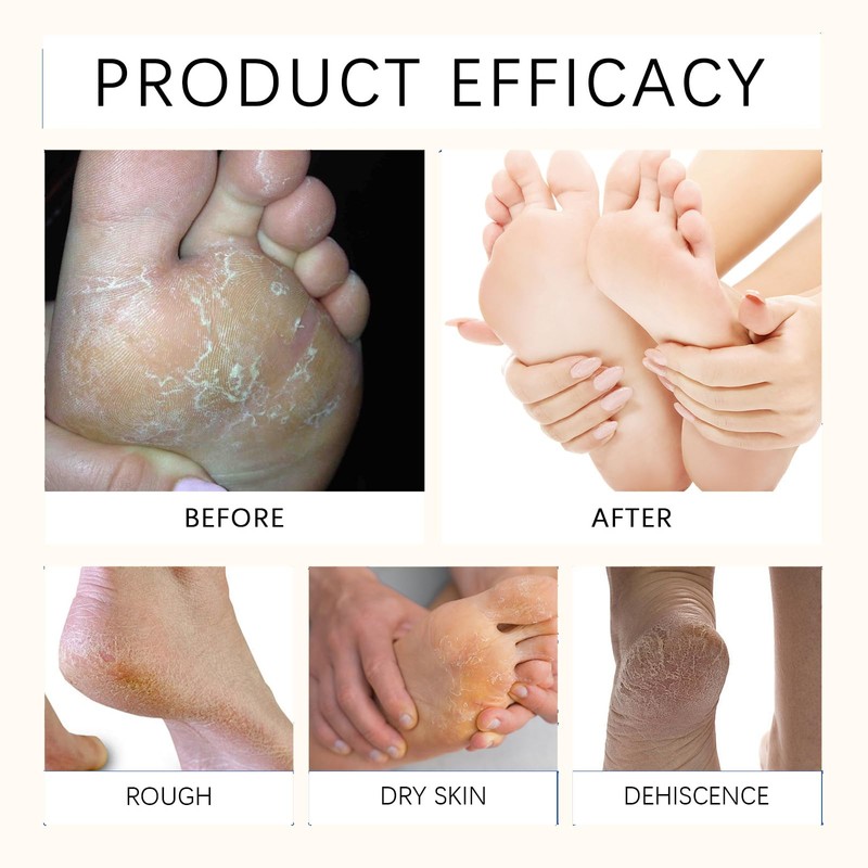 Urea Cream 60 Percent for Feet-Urea Foot Cream Deep Moisturizing