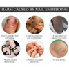 Nail Corrector Pedicure ment Foot Care Tool, 12Pcs/Box Toenail Correction