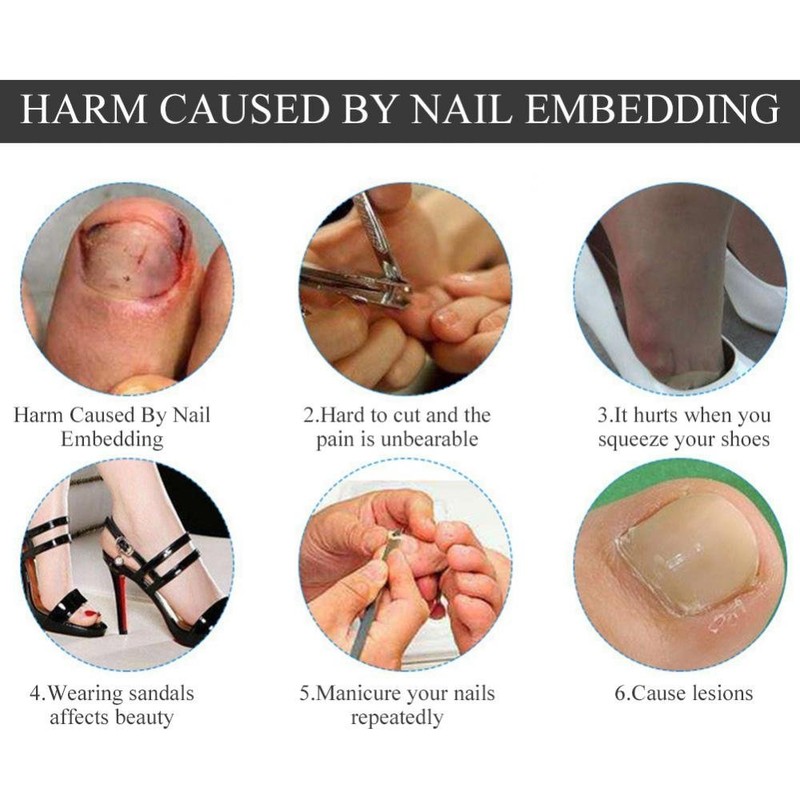 Nail Corrector Pedicure ment Foot Care Tool, 12Pcs/Box Toenail Correction