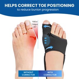 lifeflare 2pcs Bunion Corrector for Women & Men, Adjustable Big Toe Straightener with Bunion Fix and Pads, Bunions Correction Splint, Comfortable Breathable Hallux Valgus Relief for Day/Night Use