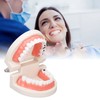 Dental Disease Caries Teeth Model Resin Simulation Teaching Prop Dental