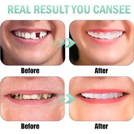 2 Pairs, Regain Confidence Smile for Women and Men, Temporarily Adjustable(White)