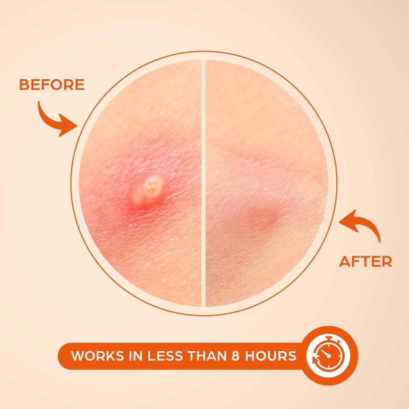 KEYCONCEPTS Pimple Patches (240 Pack), Pimple Patch Zit Patch and