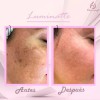 4pack Crema Facial & Corporal Luminatte Aclaradora, Melasma.
