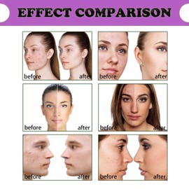 Aze/laic Aci/d 12% Face Serum,Aze/laic Ac/id for Anti Acne,Azel/aic Ac/id Face Cream,Skin Care Gel with Niacinamide,Az/elaic A/cid Cream,Ro/sacea Crea/m for Face,Dark Spot Remover,Acne Crea/m for Face