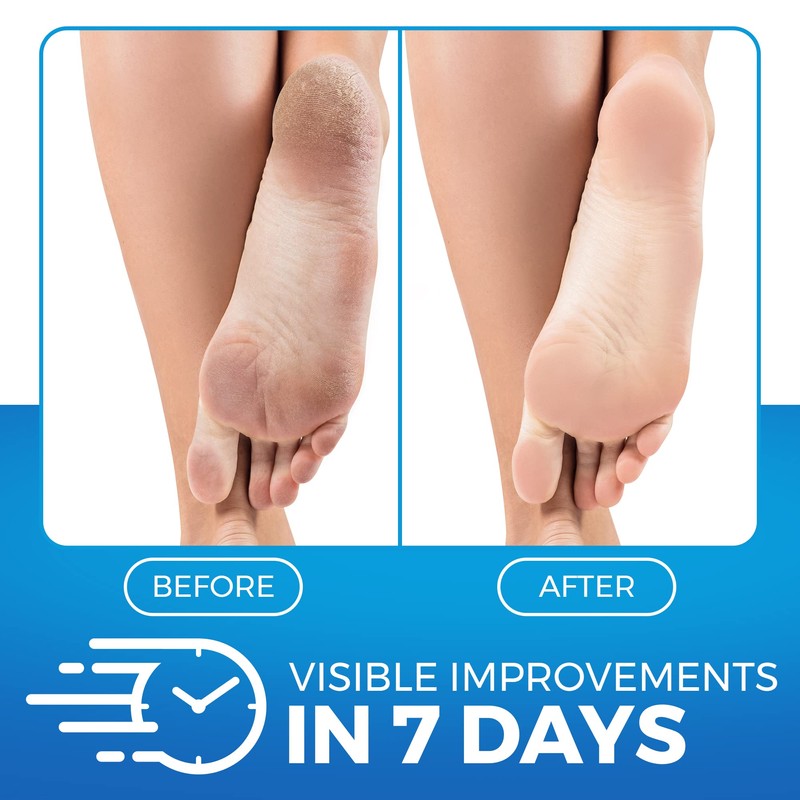 Imperial Feet Urea Foot Balm - Natural Urea Cream for