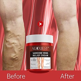 AUQUEST 80g Feet Varicose Veins Cream Treatment Relieve Dilated Capillaries Removal Phlebitis Spider Leg Veins Varicose Cream