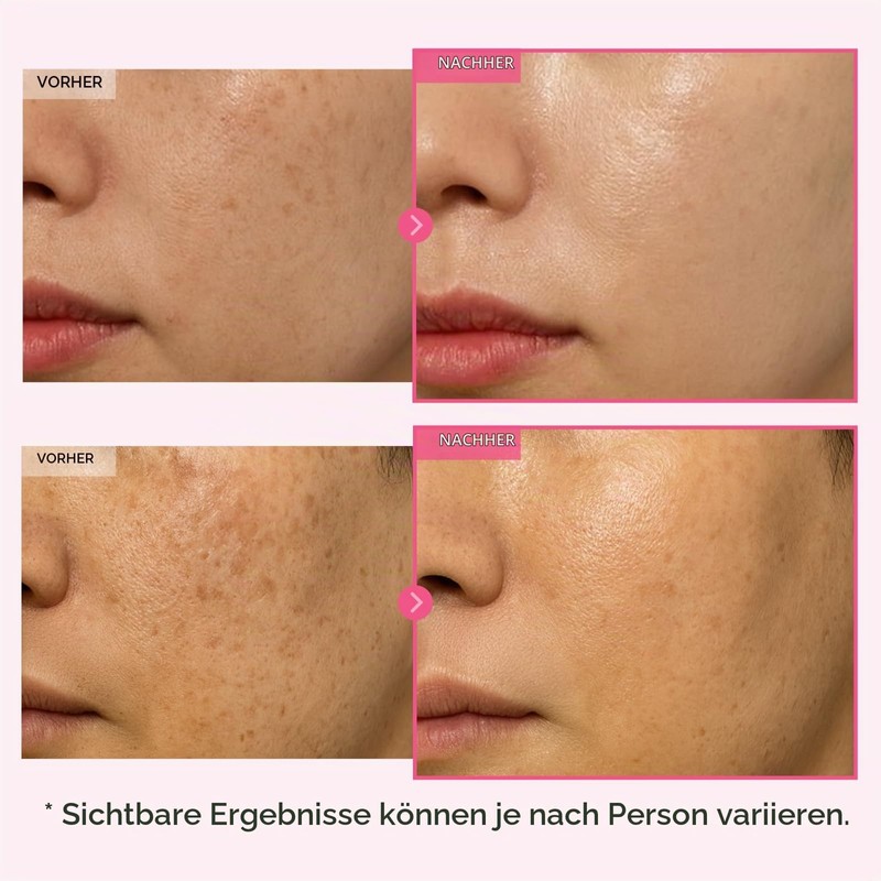 TOSOWOONG Arbutin 7% Glutathione Cream, Dark Spots, Even Complexion, Glow