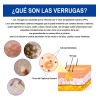 Líquida De Eliminación De Verrugas Y Mezquinos 30ml