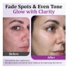 Highly Effective Anti-pigmentation Serum Whitening Blemish R