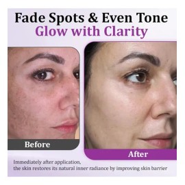 Highly Effective Anti-pigmentation Serum Whitening Blemish R