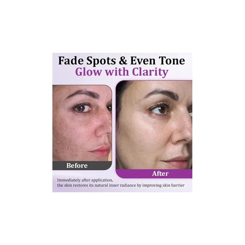 Highly Effective Anti-pigmentation Serum Whitening Blemish R