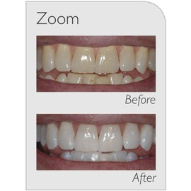 Zoom 10% Nite White Carbamide Peroxide Teeth Whitening Gel Complete Kit | 6 x 2.4gram Syringes | Zipper Bag & Mouth Tray Case Included