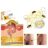Crema Antipigmentaria Para Eliminar Las Verrugas Del Herpes,