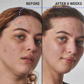 The INKEY List SuperSolutions Urea 10% Moisturizer, Quickly Helps to Hydrate, Nourish and Soothe Dry Skin, Gently Exfoliates, Urea Moisturizer for Face, 1.69 fl oz