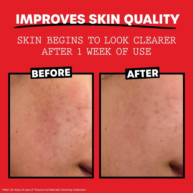 THAYERS Witch Hazel Blemish Cleanser, 4 Ounce