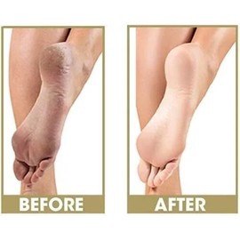 ProLinc Be Natural Callus Eliminator Original 128 fl oz, 1 Gallon Pedicure NEW