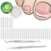 (30+2) Pack Ingrown Toenail Correction Treatment Kit, 30PCS Ingrown Toenails