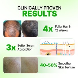 Sotrue Hair Growth Epifine Derma Roller 0.5 mm with 540 Medical Grade Stainless Steel Needles, Activates Hair Follicles, Repairs Damaged Hair, For Face, Hair Fall & Hair Thickening, Reduces Acne Scars, Safe & Effective To Use