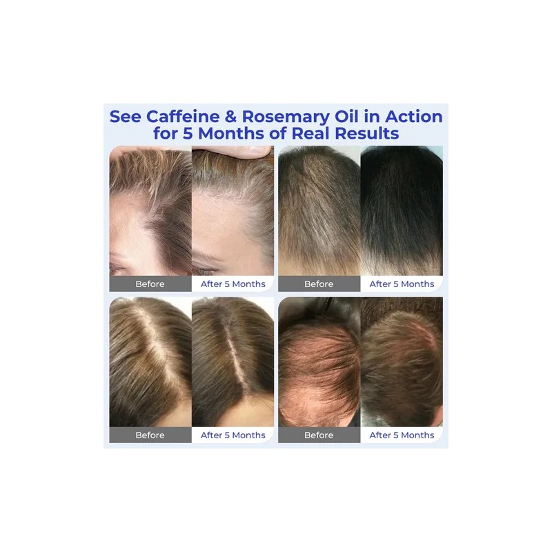 Serum Para El Crecimiento Del Cabello Eoiroa Con 3% De