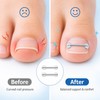 Toenail Care Brace Stickers for Daily Wear – 2PCS Flexible