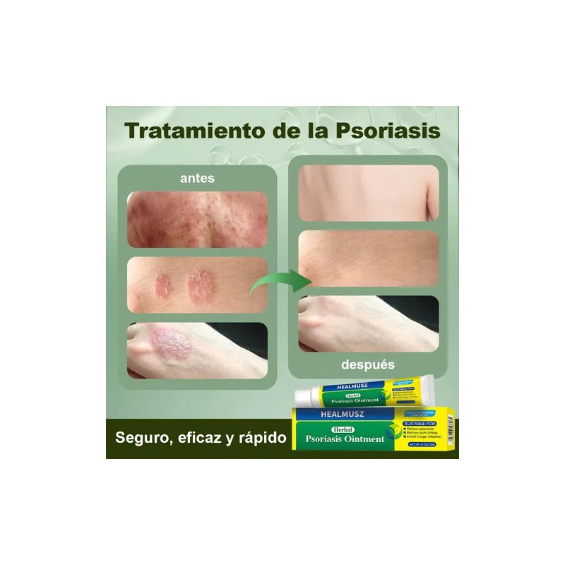 Crema De Psoriasis Para Varios Síntomas De Psoriasis 20g