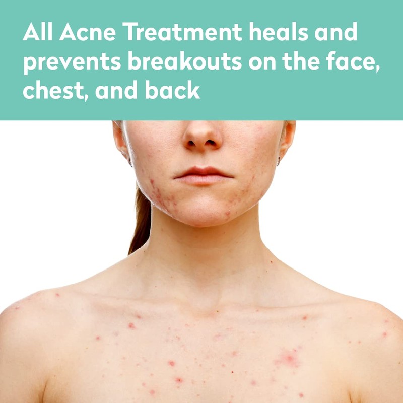 All Acne Treatment - Face and Body - Spot and
