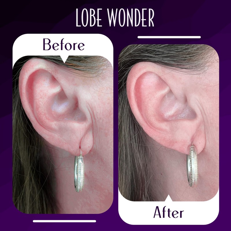 Lobe Wonder - The ORIGINAL Ear Lobe Support Patch for