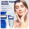 Acne Clean Foam Cleanser, 170 g Acne Foaming Wash Acne