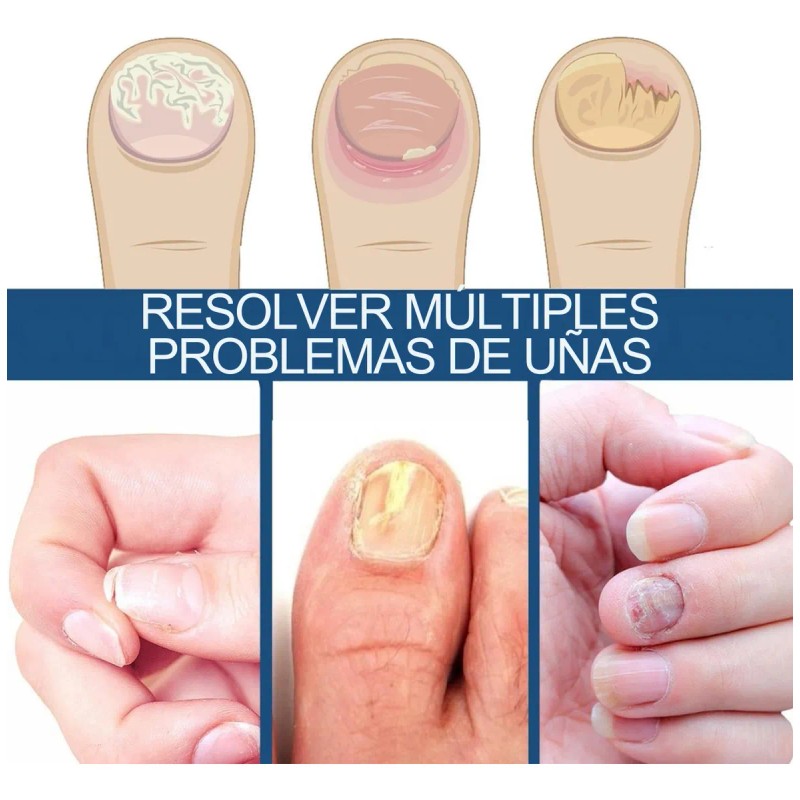 32 Parches Reparación Uñas + 1 Lampara Eliminar Hongos Pie