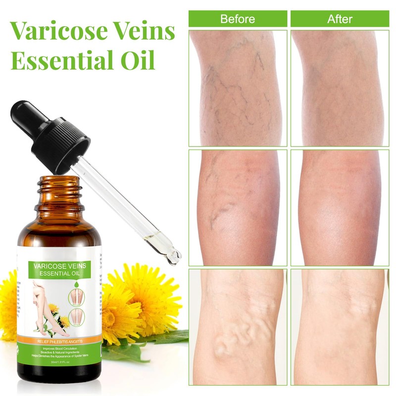 Varicose Veins Essential Oil, Spider Vein Removal Oil for Legs,