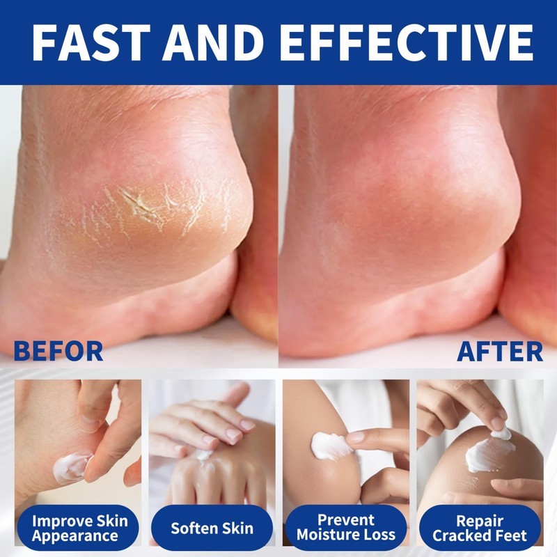 60% Urea Cream,Cracked Heel Repair Cream for Feet and Hand