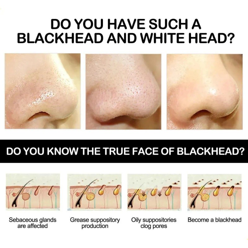 Mascarilla Exfoliante Eliminar Puntos Negros.