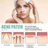 396Pcs Blemish Patches Facial Pimple Zit Spot Stickers Mild Non