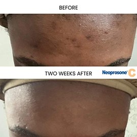 NEOPROSONE Serum Vitamina C Facial con Vitamina C al 20% y Alfa Arbutina, Tratamiento Despigmentante Aclarante Blanqueador, Hidrata y Trata Líneas de 
